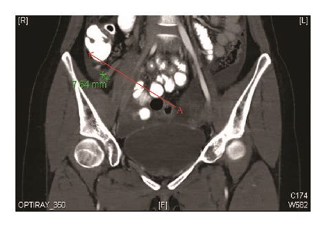 Ct Scan A Inflamed Appendix B Left Adnexal Mass Download