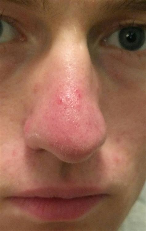 Skin Concerns Do I Have Rosacea On My Nose Skincareaddiction
