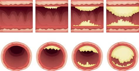 Atherosclerosis Causes Symptoms Treatment And Lifestyle Changes