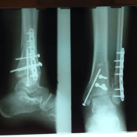 Compound Fracture Of Tibia And Fibula Recovery