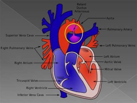 Seminar Congenital Cardiac Disorders Pdata And Ap Window