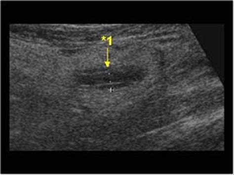 Abdomen And Retroperitoneum 15 Appendix Case 153 Complicated