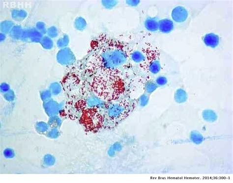 Mycobacterium Leprae In Bone Marrow Hematology Transfusion And Cell