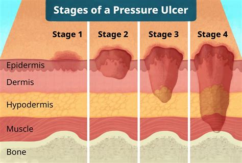Pressure Ulcer Bedsore Treatment For Stages Through