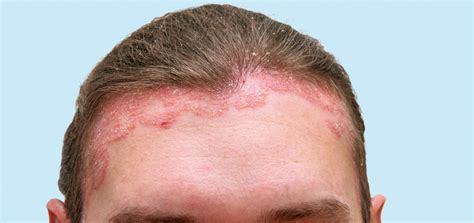 Doenças Do Couro Cabeludo Foliculite Pitiríase E Alopecia