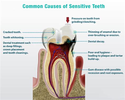 why are my teeth sensitive explanations and treatment options