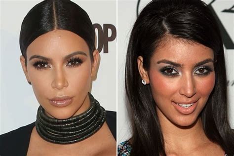 Kim Kardashian Plastic Surgery Journey Before And After