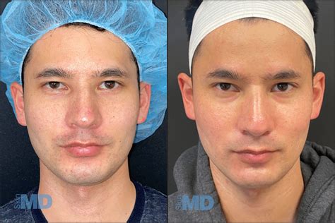 Pico Genesis Boston Skin Md Laser And Cosmetic Group