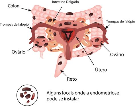 Endometriose ist eine weitgehend unbekannte erkrankung. Endometriose profunda: Entenda como funciona o nível mais ...