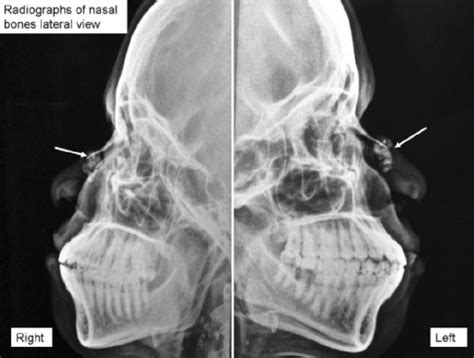 Orbital rims, maxillae, nasal septum, zygomatic bones, and anterior nasal spine. Radiographs of the nasal bones showing subcutaneous cal ...