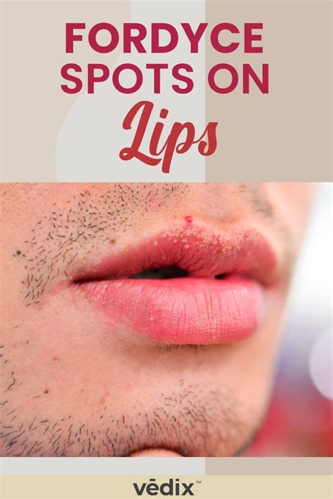Fordyce Spots On Lips Fordyce Lip Treatment Lips