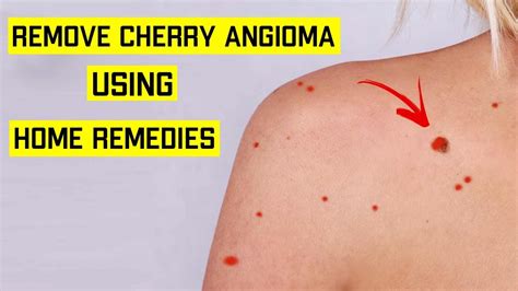 How To Get Rid Of Cherry Angioma Naturally Top 5 Home Remedies For Cherry Angiomas Red Moles