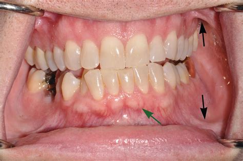 9 Oral Mucosa And Mucosal Sensation Pocket Dentistry