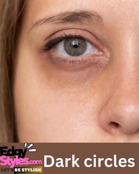 Dark Circles Causes Prevention Treatment Edgy Styles
