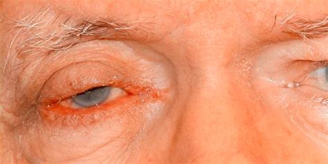 Eyelid Skin Cancer Photos