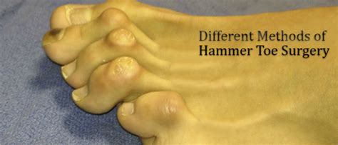 Different Methods Of Hammer Toe Surgery Uk
