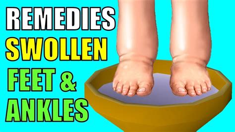 5 Effective Natural Remedies For Swollen Feet And Ankles Edema Youtube