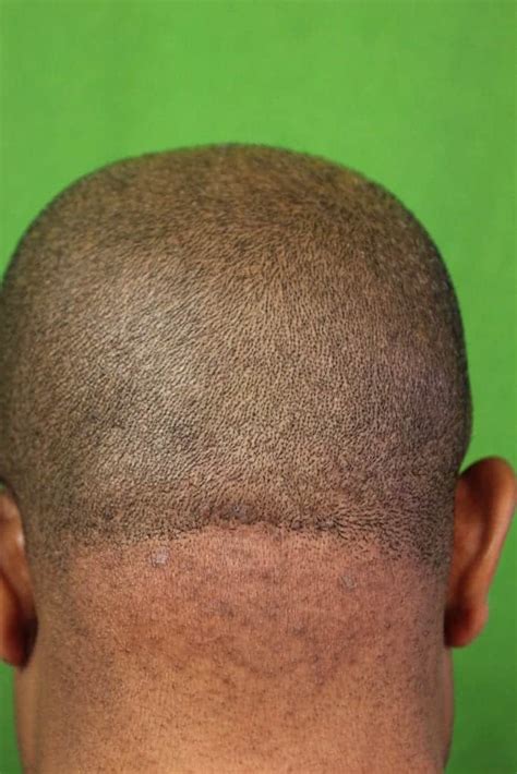 Video Laser Treatment For Bumps On Back Of Head By Dr U