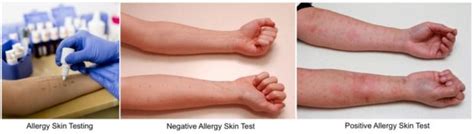 Allergy Skin Testing Asthma Allergy Clinic