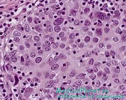 Диета рак шейки матки Классификация патоморфологии рака шейки матки. Рекомендации Классификация патоморфологии рака шейки матки. Рекомендации Диета рак шейки матки