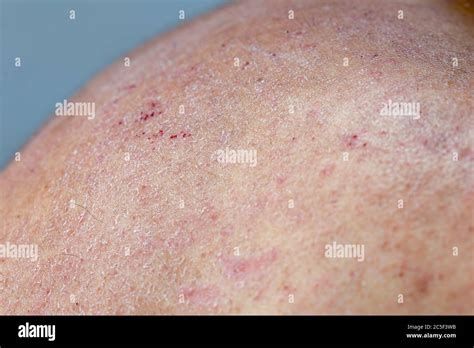 Extreme Close Up Photography Of The Atocpic Dermatitis Symptoms On The