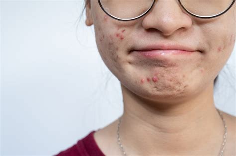 Treating Teenage Acne Dermatology Advisor