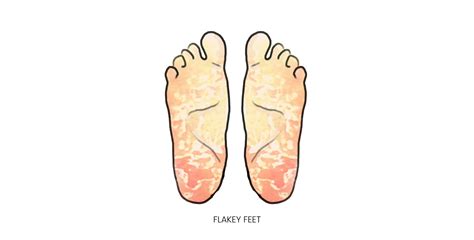 4 Things Your Feet Tell You About Your Health Sikasok