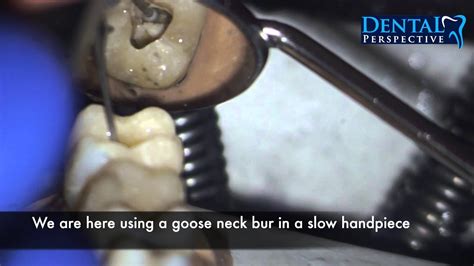 Lower Second Molar Access Cavity Endo Hd Dental Perspective Youtube