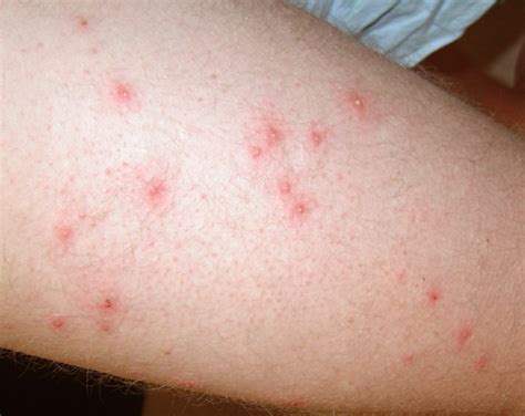 Itchy Red Bumps On Skin12 Common Causes With Treatment