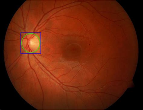 The Steps Of Our Method To Detect Ods In Normal Fundus Photography And