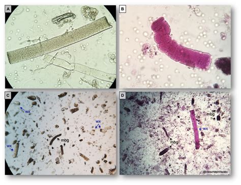 Urine Sediment Of The Month Urinal Sediment Microscopy
