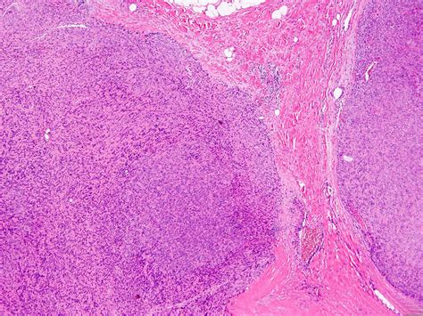 Pathology Outlines Myoepithelioma Myoepithelial Carcinoma Mixed Tumor