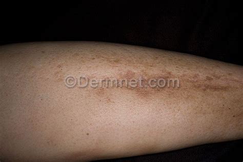 Diabetic Dermopathy Overview And Pictures