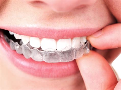 Invisalign Archives New Smile Orthodontics