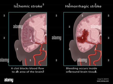Accidente cerebrovascular isquémico y hemorrágico Ilustración