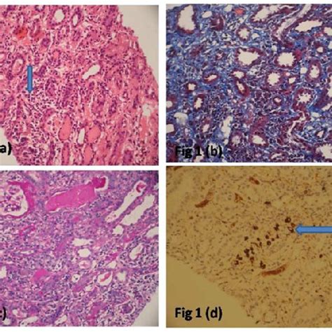 A Section Through Kidney Biopsy Shows Interstitial Fibrosis With