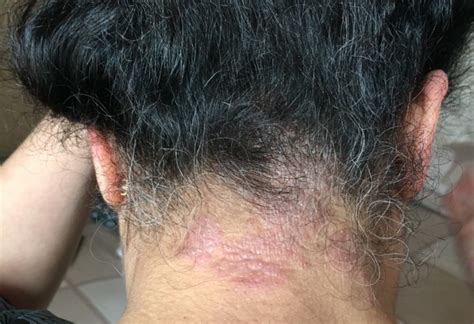 Please Help Me With This Behind My Neck And Hairline Eczema Dermatitis And Eczema Skin And
