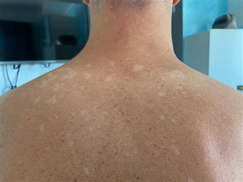 Exploring The Common Causes And Treatments Of White Spots On The Skin Breaking Latest News