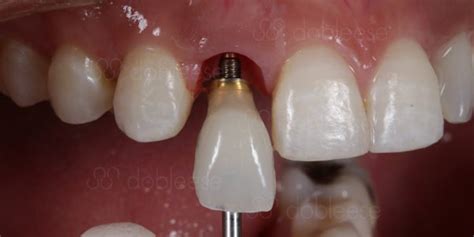 Fant Stico Adivinar Disparates Implantes Dentales Atornillados