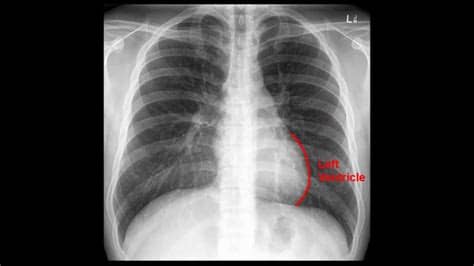 You'll have to remove all of your clothes and jewelry from the waist up, and wear a hospital gown. Chest x-ray interpretation - YouTube