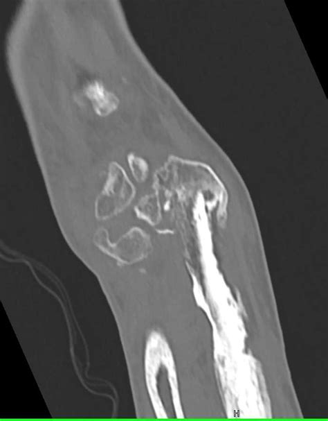 Chronic Osteomyelitis Musculoskeletal Case Studies Ctisus Ct Scanning