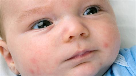 Why Does My Baby And Child Develop Eczema Bellary Nature