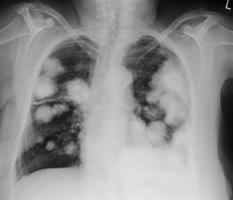 Lung Metastases 2 Radiology At St Vincents University Hospital