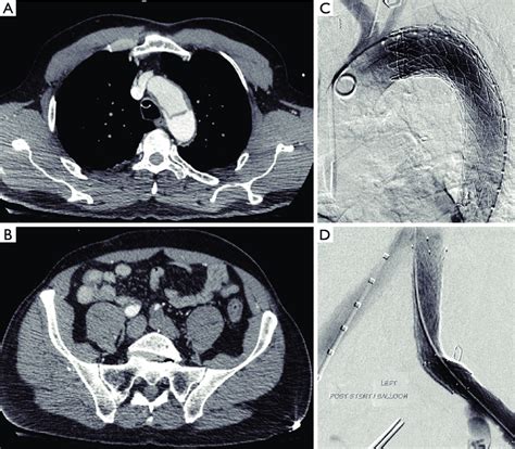 Endovascular Treatment Of Complicated Type B Aortic Dissection With Llm