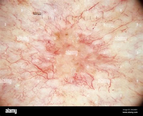 Basal Cell Carcinoma Dermoscopy Stock Photo Alamy