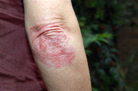 Psoriasis What It Is Causes Triggers Diagnosis And Treatment