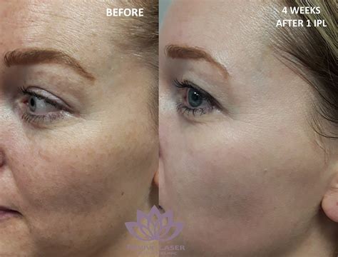 Ipl Laser Before And After Ipl Photofacial Reveal Your Radiance