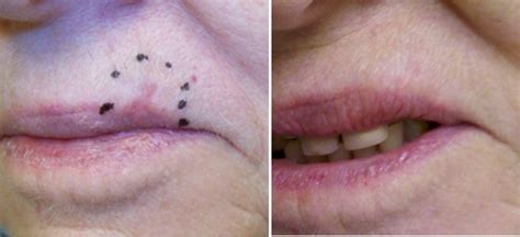 Pics Of Melanoma On Lips