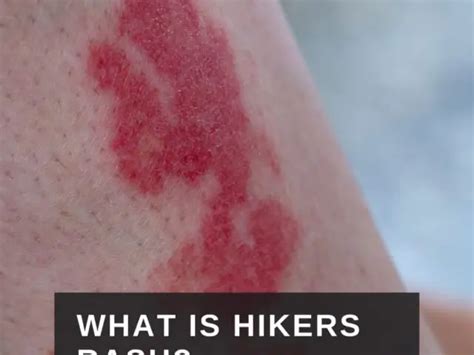 Hikers Rash Problems With Heavy Activity In Hot Weather
