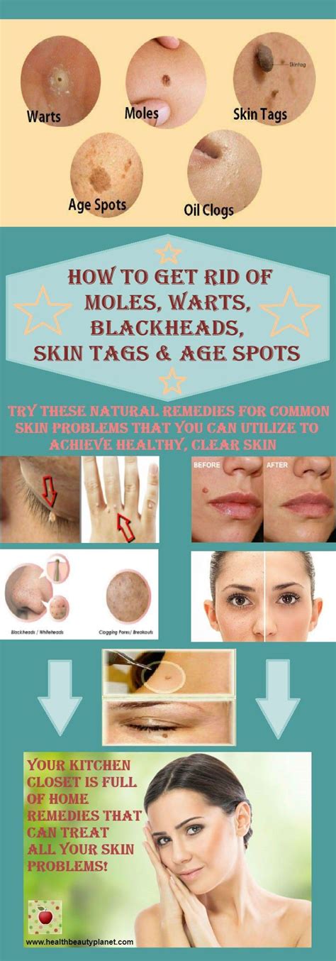 They will finish by stitching up the skin around the mole. How to Get Rid of Moles, Warts, Blackheads, Skin Tags and ...